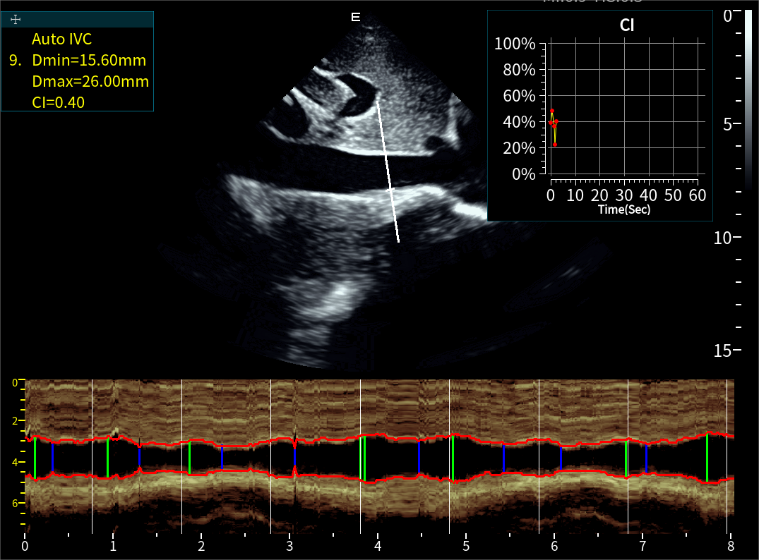Auto IVC下腔靜脈自動測量