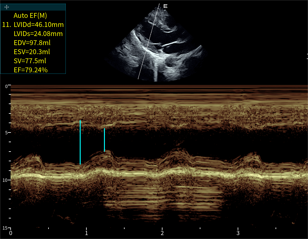 Auto EF(M)射血分數自動測量